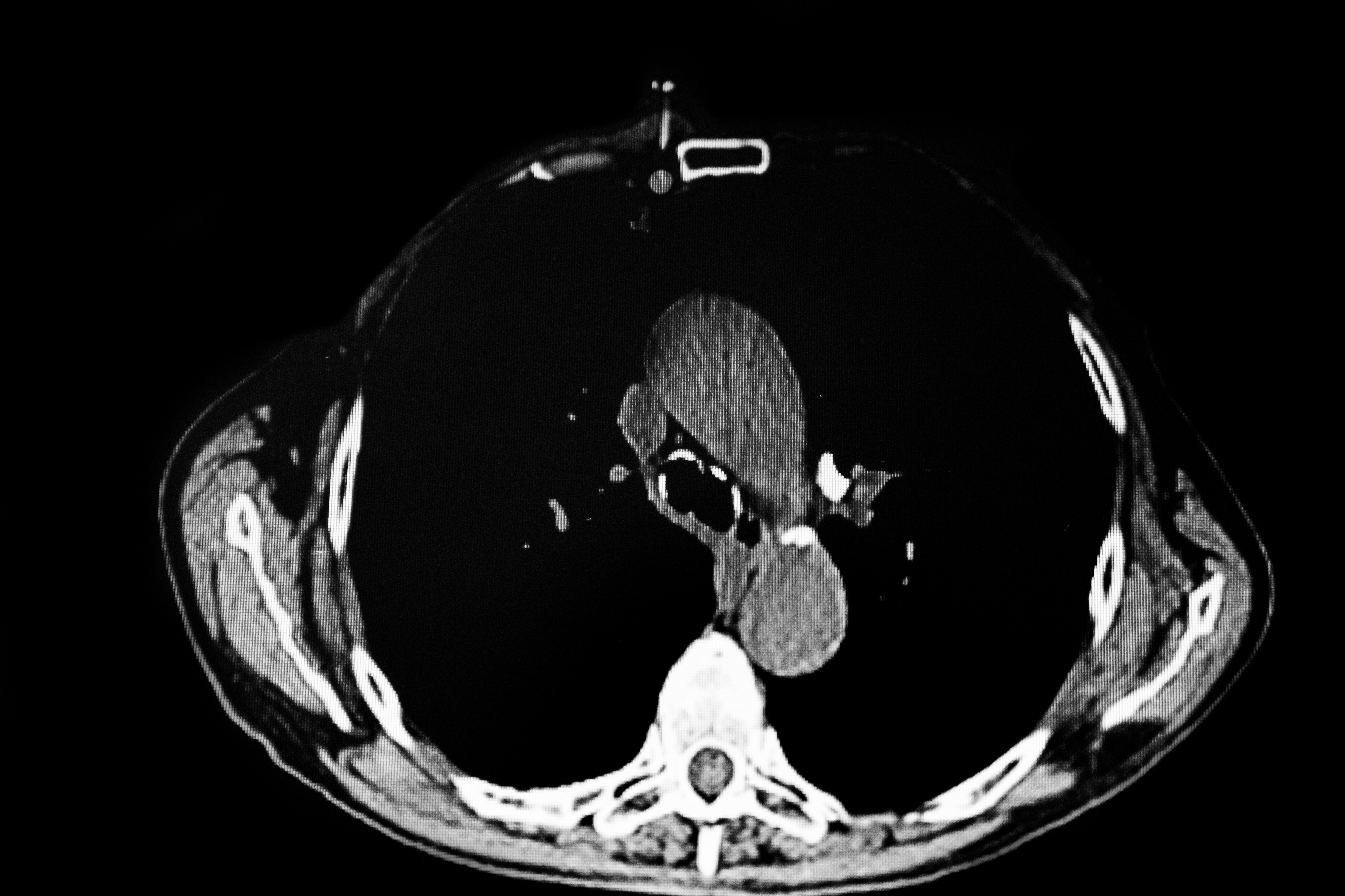 除外診断としての胸部CT